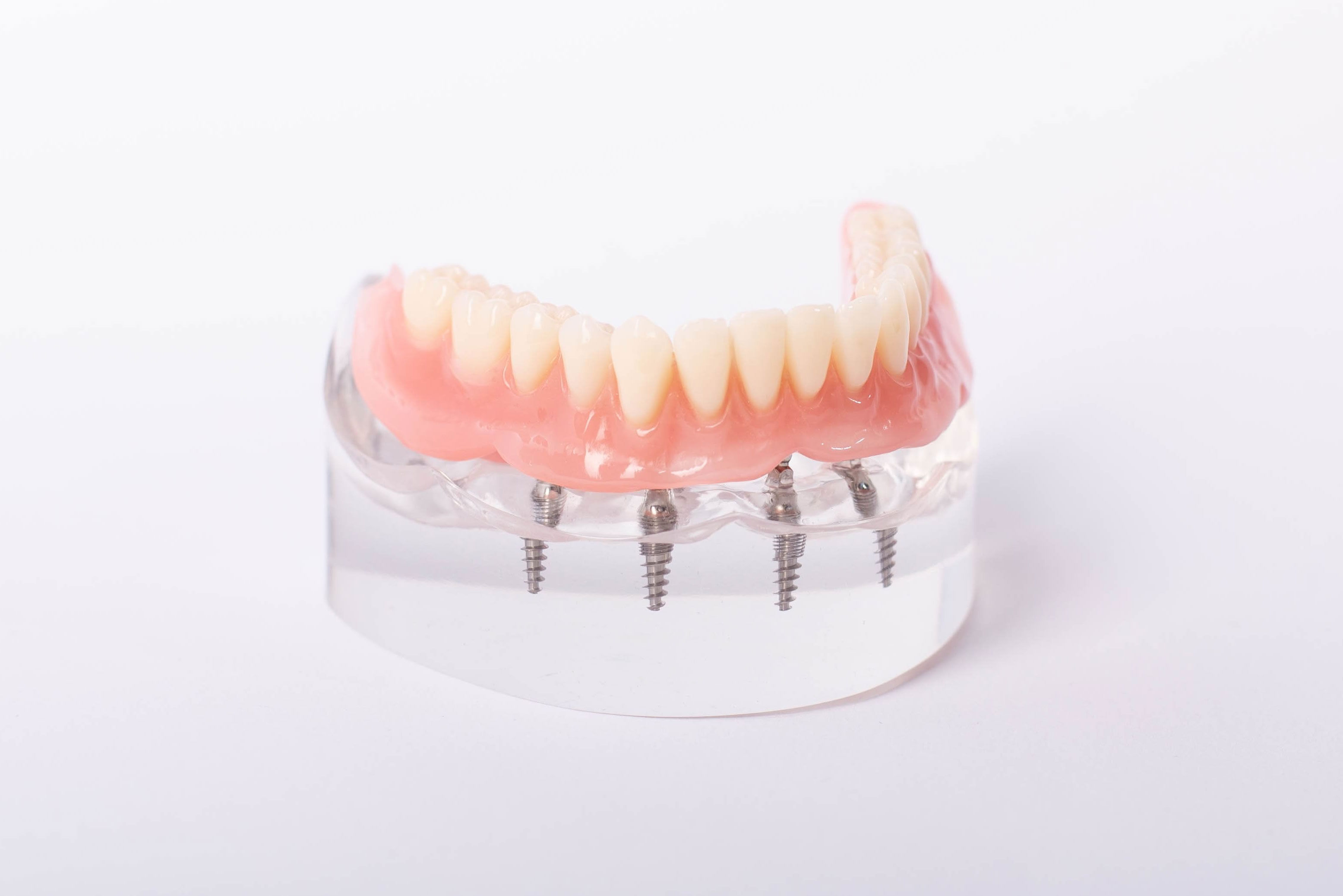 部分入れ歯（部分義歯）