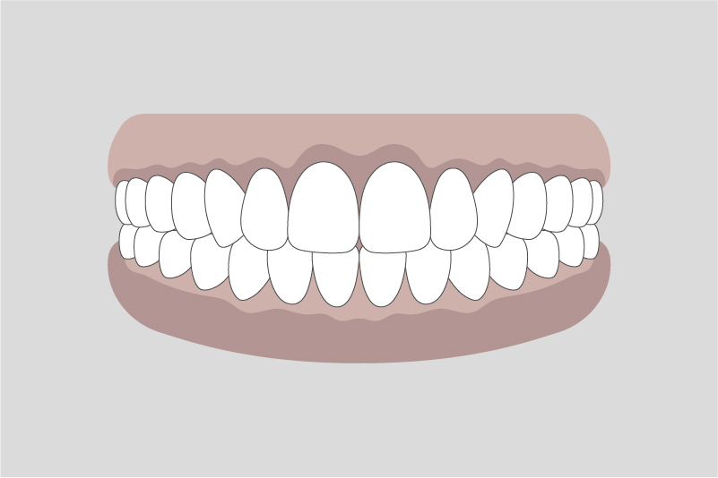 ガムピーリング（歯ぐきの黒ずみを改善）
