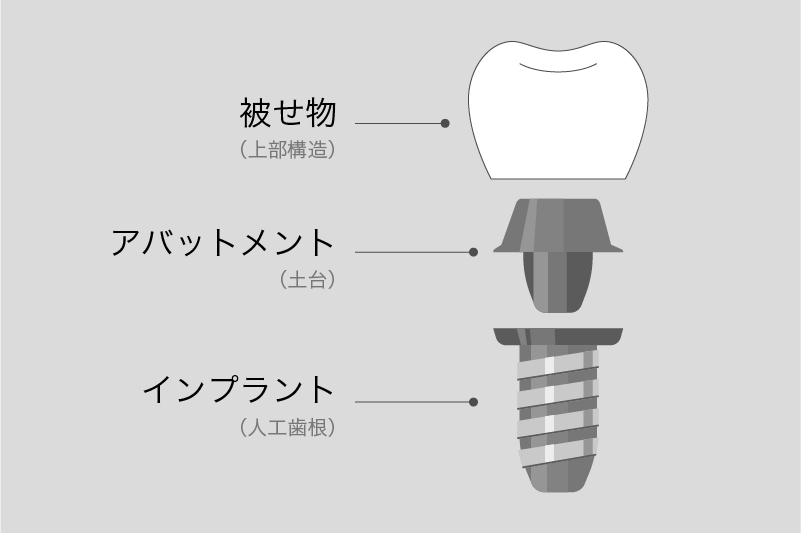 人工歯の装着（アバットメント・上部構造）